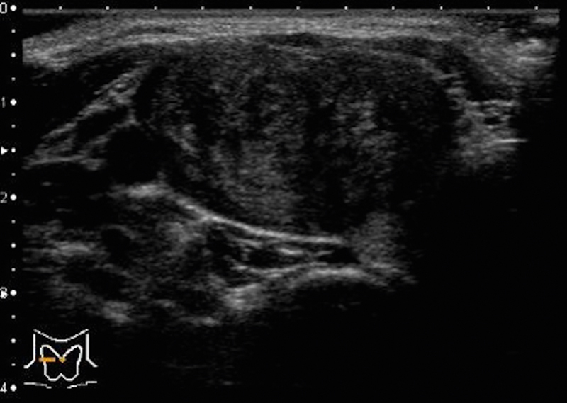 Can Ultrasound Alone Predict Papillary Thyroid Carcinoma with Desmoid-Type Fibromatosis? A Retrospective Analysis of 13 Cases, Focusing on the Stromal Area.