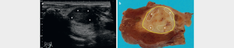 Can Ultrasound Alone Predict Papillary Thyroid Carcinoma with Desmoid-Type Fibromatosis? A Retrospective Analysis of 13 Cases, Focusing on the Stromal Area.