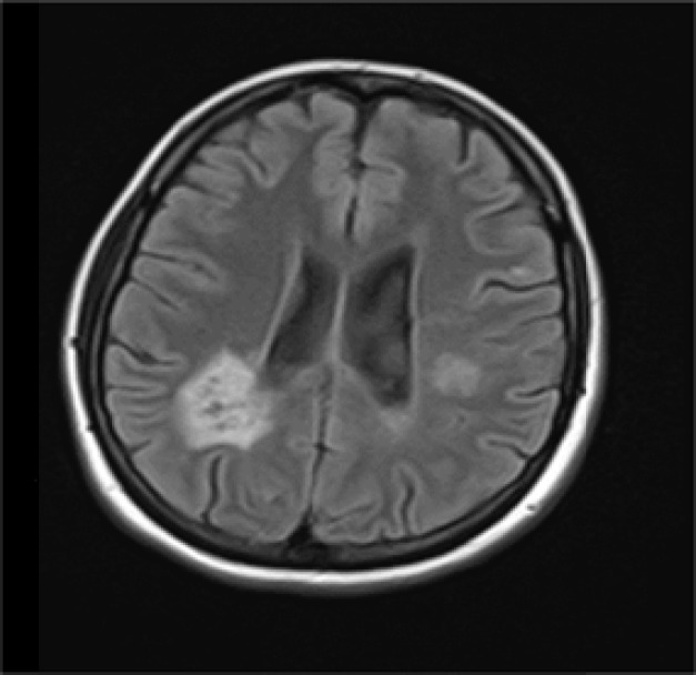 The pathologic and diagnostic in magnetic resonance imaging of brain and cervical spine of patients with neuromyelitis optica spectrum disorder.