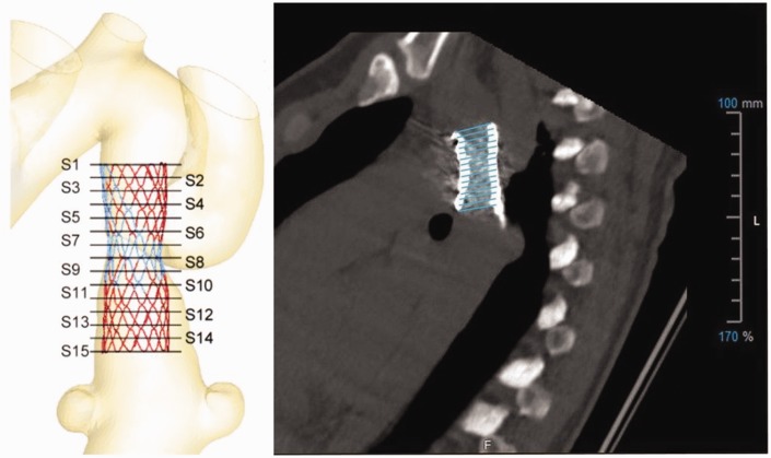 Evaluation of a modified Cheatham-Platinum stent for the treatment of aortic coarctation by finite element modelling.