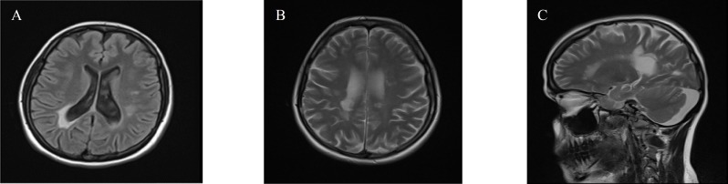 The pathologic and diagnostic in magnetic resonance imaging of brain and cervical spine of patients with neuromyelitis optica spectrum disorder.