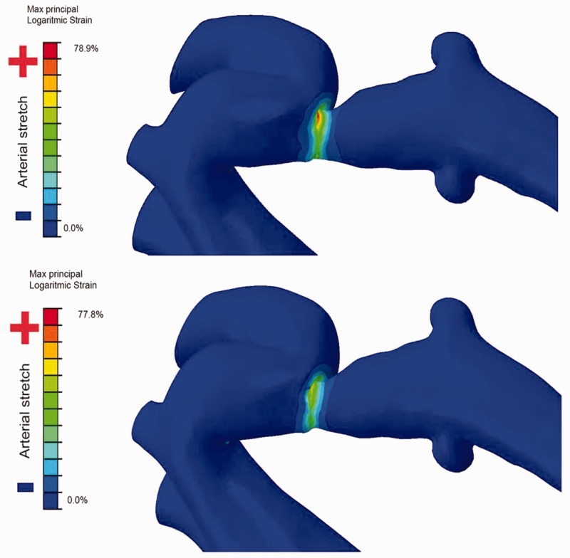 Evaluation of a modified Cheatham-Platinum stent for the treatment of aortic coarctation by finite element modelling.