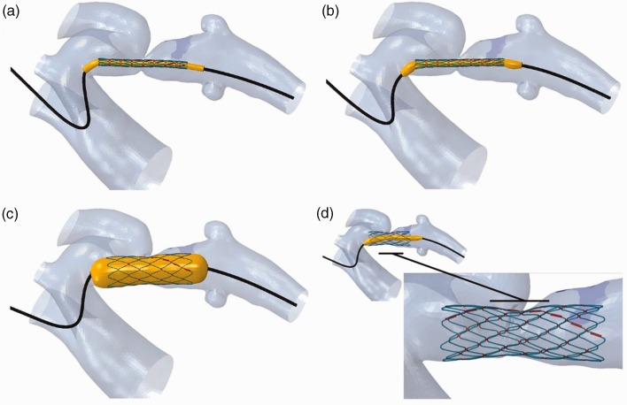 Evaluation of a modified Cheatham-Platinum stent for the treatment of aortic coarctation by finite element modelling.