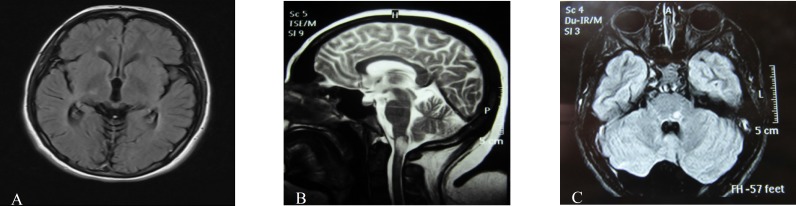 The pathologic and diagnostic in magnetic resonance imaging of brain and cervical spine of patients with neuromyelitis optica spectrum disorder.