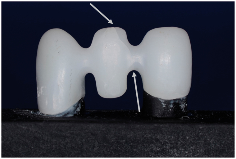 Fracture load of colored and non-colored high translucent zirconia three-unit fixed dental prosthesis frameworks.