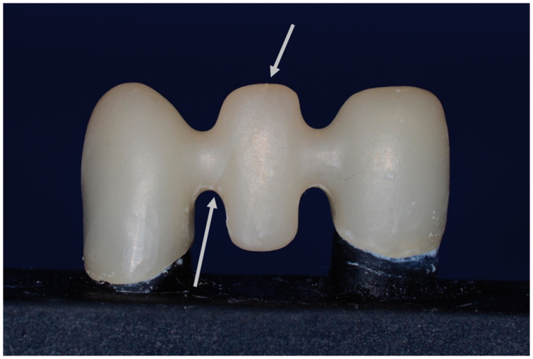 Fracture load of colored and non-colored high translucent zirconia three-unit fixed dental prosthesis frameworks.