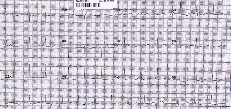 Non-ST-Elevation Myocardial Infarction in a Case of Von Willebrand Disease: a Case Report.