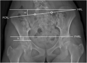 Evaluation of functional and structural leg length discrepancy in patients with adolescent idiopathic scoliosis using the EOS imaging system: a prospective comparative study.