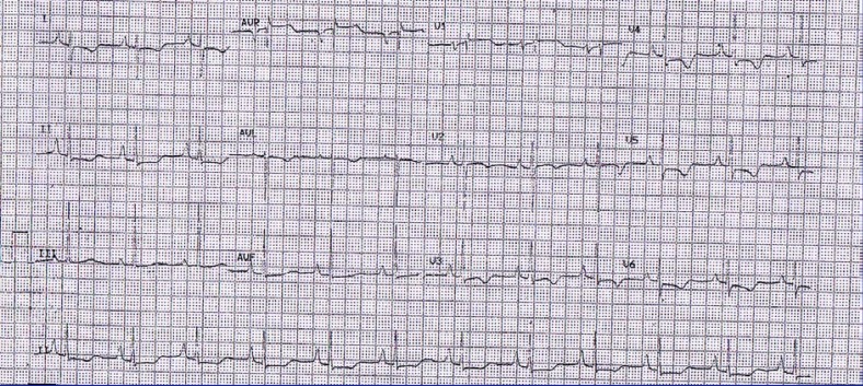 Non-ST-Elevation Myocardial Infarction in a Case of Von Willebrand Disease: a Case Report.