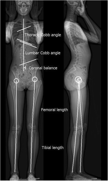 Evaluation of functional and structural leg length discrepancy in patients with adolescent idiopathic scoliosis using the EOS imaging system: a prospective comparative study.