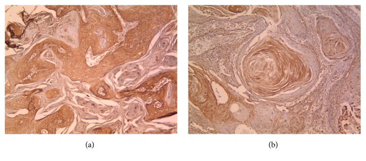 CD20+ Tumor Infiltrating B Lymphocyte in Oral Squamous Cell Carcinoma: Correlation with Clinicopathologic Characteristics and Heat Shock Protein 70 Expression.