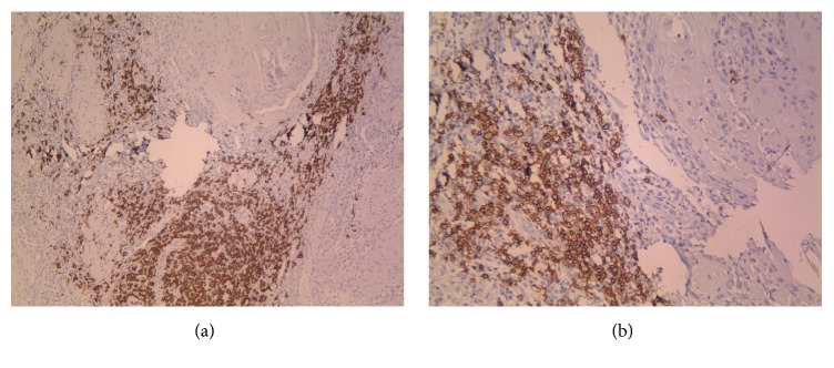 CD20+ Tumor Infiltrating B Lymphocyte in Oral Squamous Cell Carcinoma: Correlation with Clinicopathologic Characteristics and Heat Shock Protein 70 Expression.