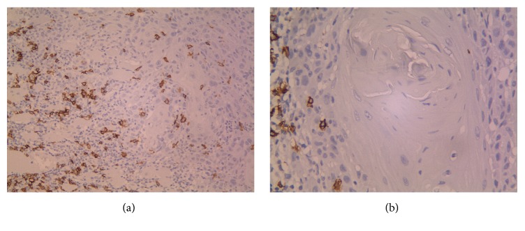CD20+ Tumor Infiltrating B Lymphocyte in Oral Squamous Cell Carcinoma: Correlation with Clinicopathologic Characteristics and Heat Shock Protein 70 Expression.