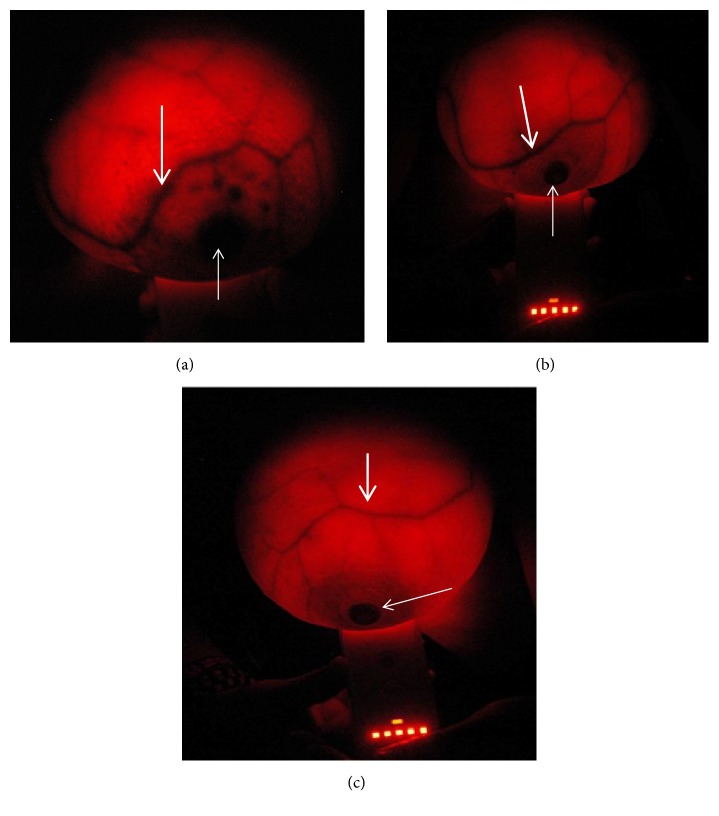 Breast-i Is an Effective and Reliable Adjunct Screening Tool for Detecting Early Tumour Related Angiogenesis of Breast Cancers in Low Resource Sub-Saharan Countries.