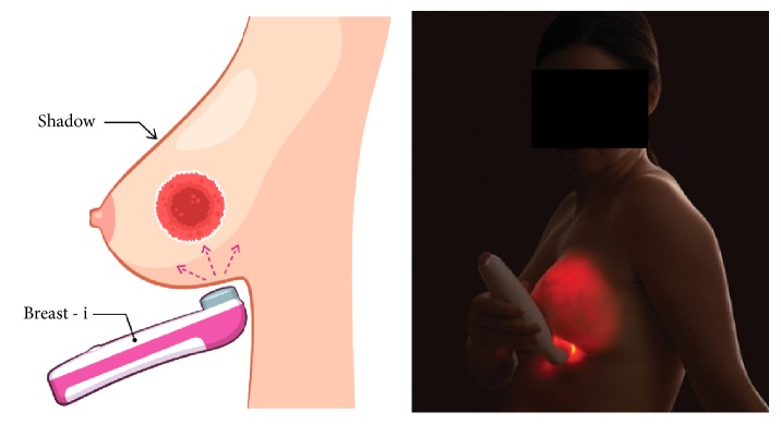 Breast-i Is an Effective and Reliable Adjunct Screening Tool for Detecting Early Tumour Related Angiogenesis of Breast Cancers in Low Resource Sub-Saharan Countries.