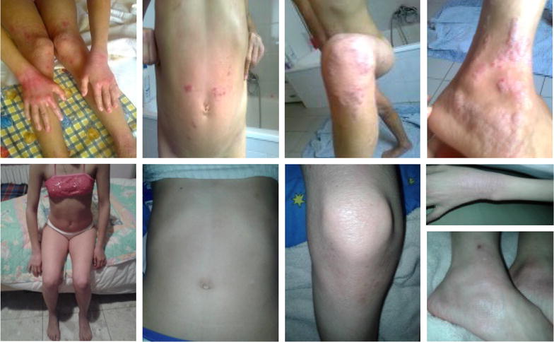 A case of atopic dermatitis caused by <i>Ascaris lumbricoides</i> infection.