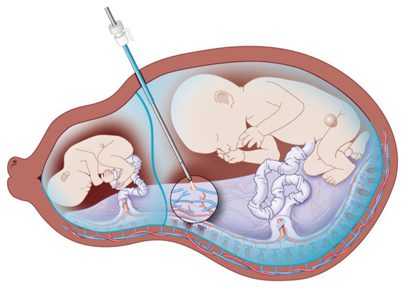 Haptic Guidance Based on All-Optical Ultrasound Distance Sensing for Safer Minimally Invasive Fetal Surgery.