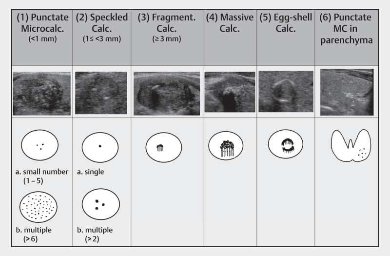 Calcifications in Thyroid Tumors on Ultrasonography: Calcification Types and Relationship with Histopathological Type.