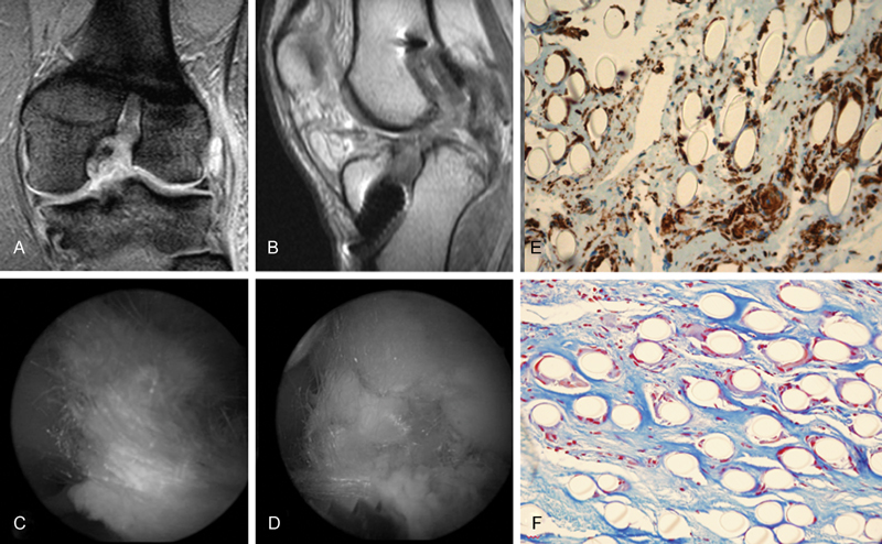 Anterior Cruciate Ligament Reconstruction with LARS Artificial Ligament-Clinical Results after a Long-Term Follow-Up.