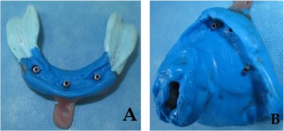 Restoring a Partial Maxillectomy Patient by an Implant-Supported Obturator on Two Implants: A Case Report.