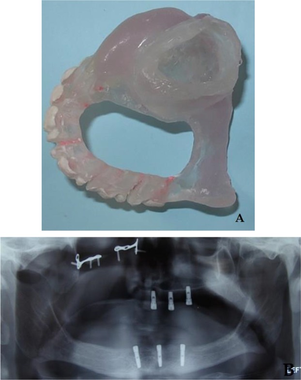 Restoring a Partial Maxillectomy Patient by an Implant-Supported Obturator on Two Implants: A Case Report.