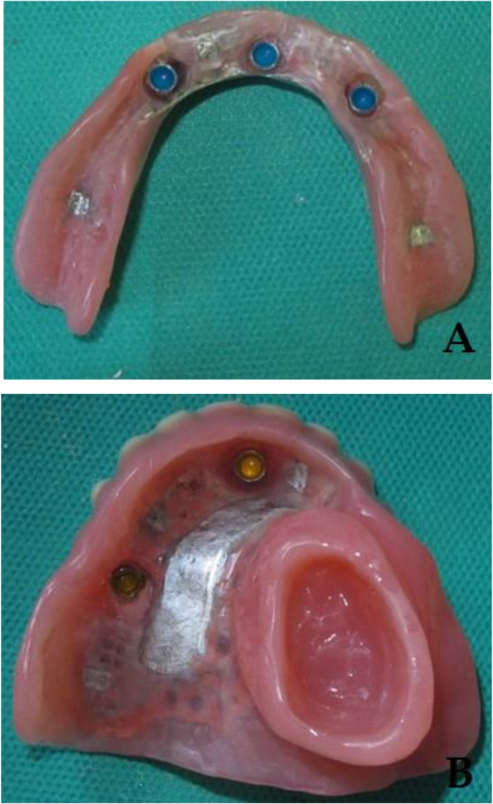 Restoring a Partial Maxillectomy Patient by an Implant-Supported Obturator on Two Implants: A Case Report.