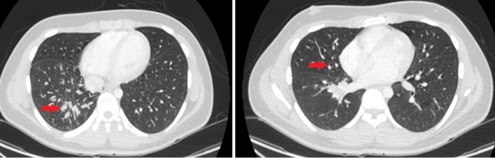 Secondary Hypogammaglobulinemia After Rituximab for Neuromyelitis Optica: A Case Report.