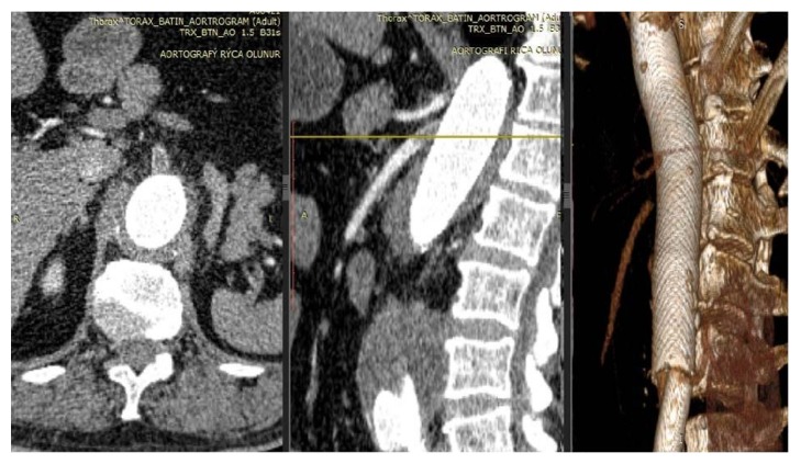 Treatment of Aortic and Iliac Artery Aneurysms with Multilayer Flow Modulator: Single Centre Experiences.