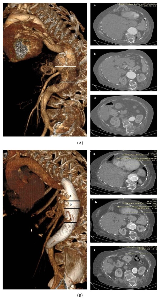 Treatment of Aortic and Iliac Artery Aneurysms with Multilayer Flow Modulator: Single Centre Experiences.