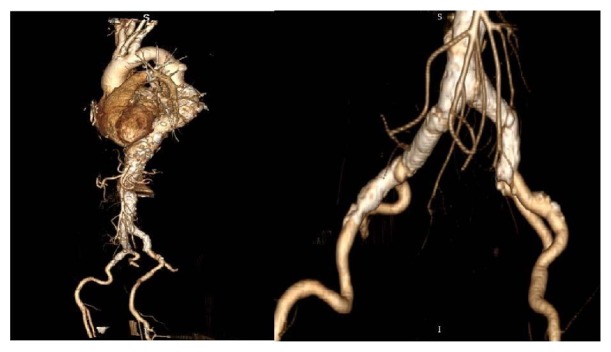 Treatment of Aortic and Iliac Artery Aneurysms with Multilayer Flow Modulator: Single Centre Experiences.