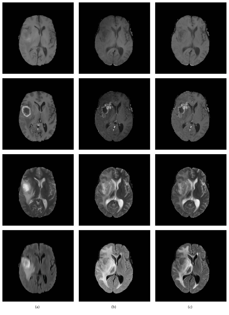 Computer-Aided Grading of Gliomas Combining Automatic Segmentation and Radiomics.