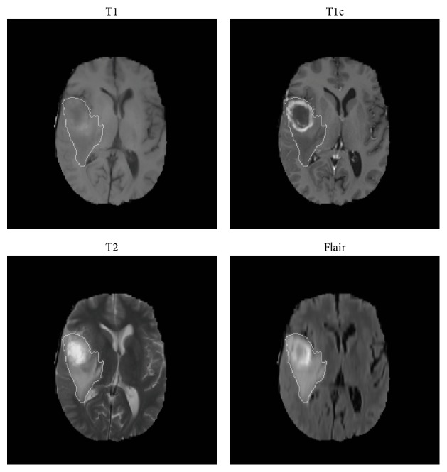 Computer-Aided Grading of Gliomas Combining Automatic Segmentation and Radiomics.