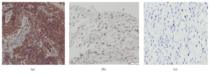 The Role of Osteocalcin and Alkaline Phosphatase Immunohistochemistry in Osteosarcoma Diagnosis.