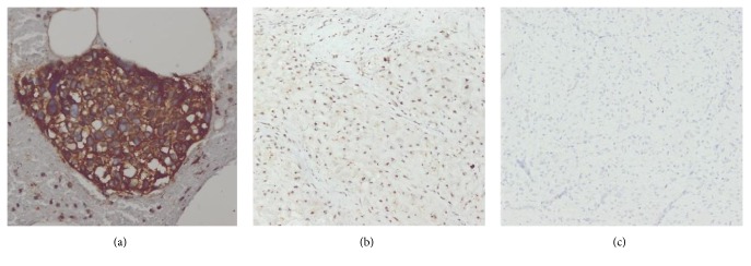 The Role of Osteocalcin and Alkaline Phosphatase Immunohistochemistry in Osteosarcoma Diagnosis.