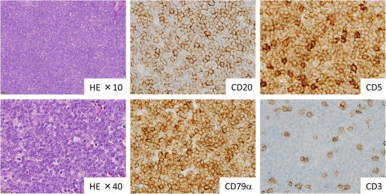 B-chronic lymphocytic leukemia showed triple transformation, to diffuse large B cell, CD20-negative, and T-cell neoplasm during ofatumumab treatment: a case report.