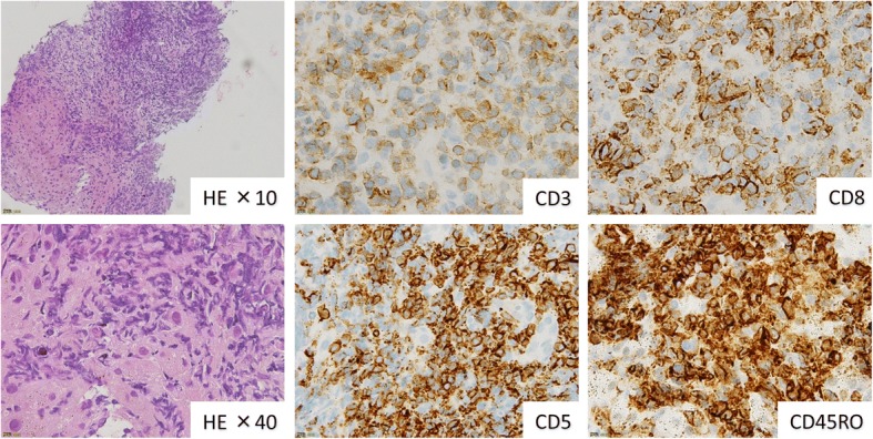 B-chronic lymphocytic leukemia showed triple transformation, to diffuse large B cell, CD20-negative, and T-cell neoplasm during ofatumumab treatment: a case report.