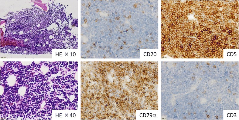 B-chronic lymphocytic leukemia showed triple transformation, to diffuse large B cell, CD20-negative, and T-cell neoplasm during ofatumumab treatment: a case report.