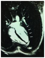 False Positive Troponin I Rendering Two Admissions for "Recurrent Acute Myopericarditis".