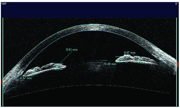 Anterior Segment Optical Coherence Tomography Analysis of Iris Morphometric Changes Induced by Prostaglandin Analogues Treatment in Patients with Primary Open Angle Glaucoma or Ocular Hypertension.