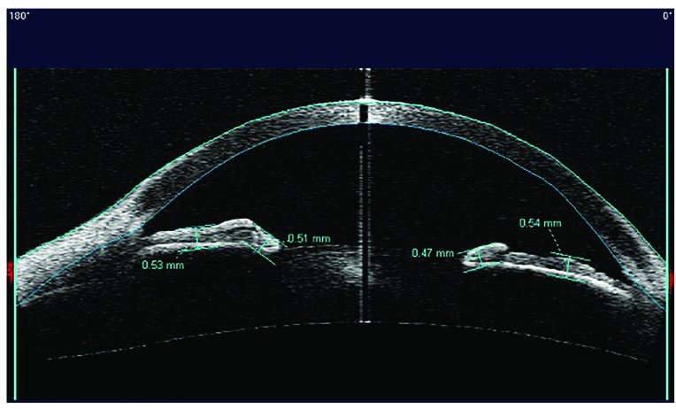 Anterior Segment Optical Coherence Tomography Analysis of Iris Morphometric Changes Induced by Prostaglandin Analogues Treatment in Patients with Primary Open Angle Glaucoma or Ocular Hypertension.