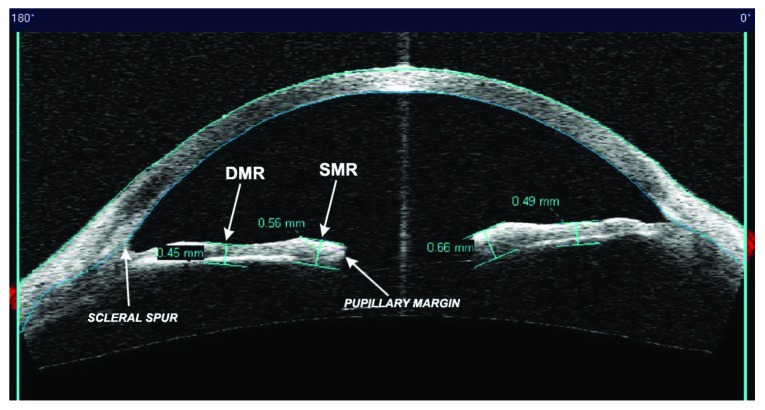 Anterior Segment Optical Coherence Tomography Analysis of Iris Morphometric Changes Induced by Prostaglandin Analogues Treatment in Patients with Primary Open Angle Glaucoma or Ocular Hypertension.