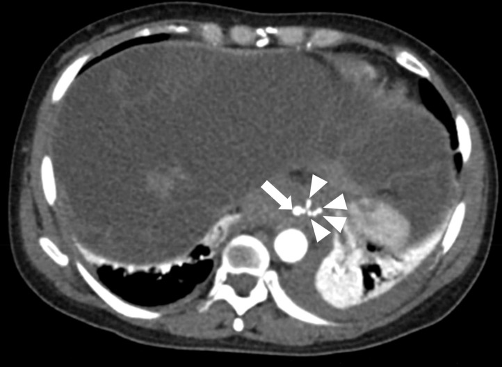 Esophageal Artery Pseudoaneurysm and Takayasu Arteritis in a Patient with Autosomal Dominant Polycystic Kidney Disease.