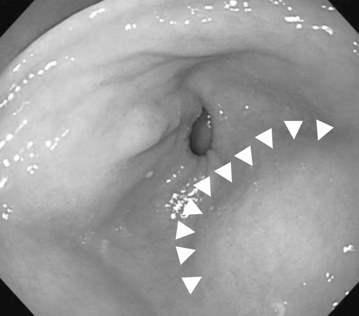 Esophageal Artery Pseudoaneurysm and Takayasu Arteritis in a Patient with Autosomal Dominant Polycystic Kidney Disease.