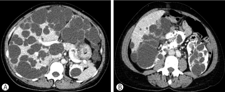 Esophageal Artery Pseudoaneurysm and Takayasu Arteritis in a Patient with Autosomal Dominant Polycystic Kidney Disease.