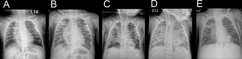 Airway Delivery of Bone Marrow-Derived Mesenchymal Stem Cells Reverses Bronchopulmonary Dysplasia Superimposed with Acute Respiratory Distress Syndrome in an Infant.