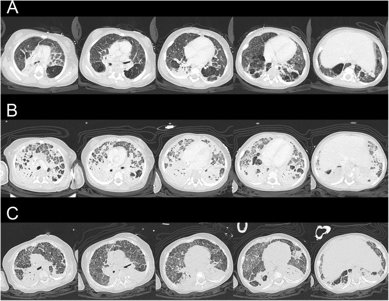 Airway Delivery of Bone Marrow-Derived Mesenchymal Stem Cells Reverses Bronchopulmonary Dysplasia Superimposed with Acute Respiratory Distress Syndrome in an Infant.