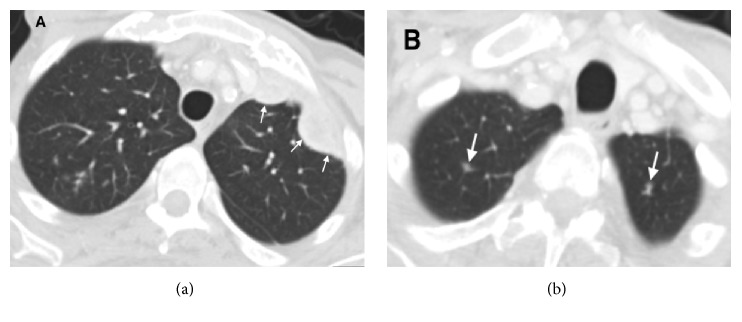 Efficacy of Nivolumab in a Patient with Metastatic Renal Cell Carcinoma and End-Stage Renal Disease on Dialysis: Case Report and Literature Review.