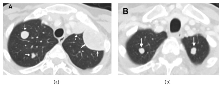 Efficacy of Nivolumab in a Patient with Metastatic Renal Cell Carcinoma and End-Stage Renal Disease on Dialysis: Case Report and Literature Review.