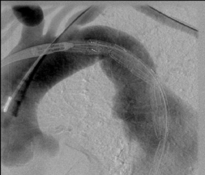 Short term outcome of thoracic endovascular aortic repair in patients with thoracic aortic diseases