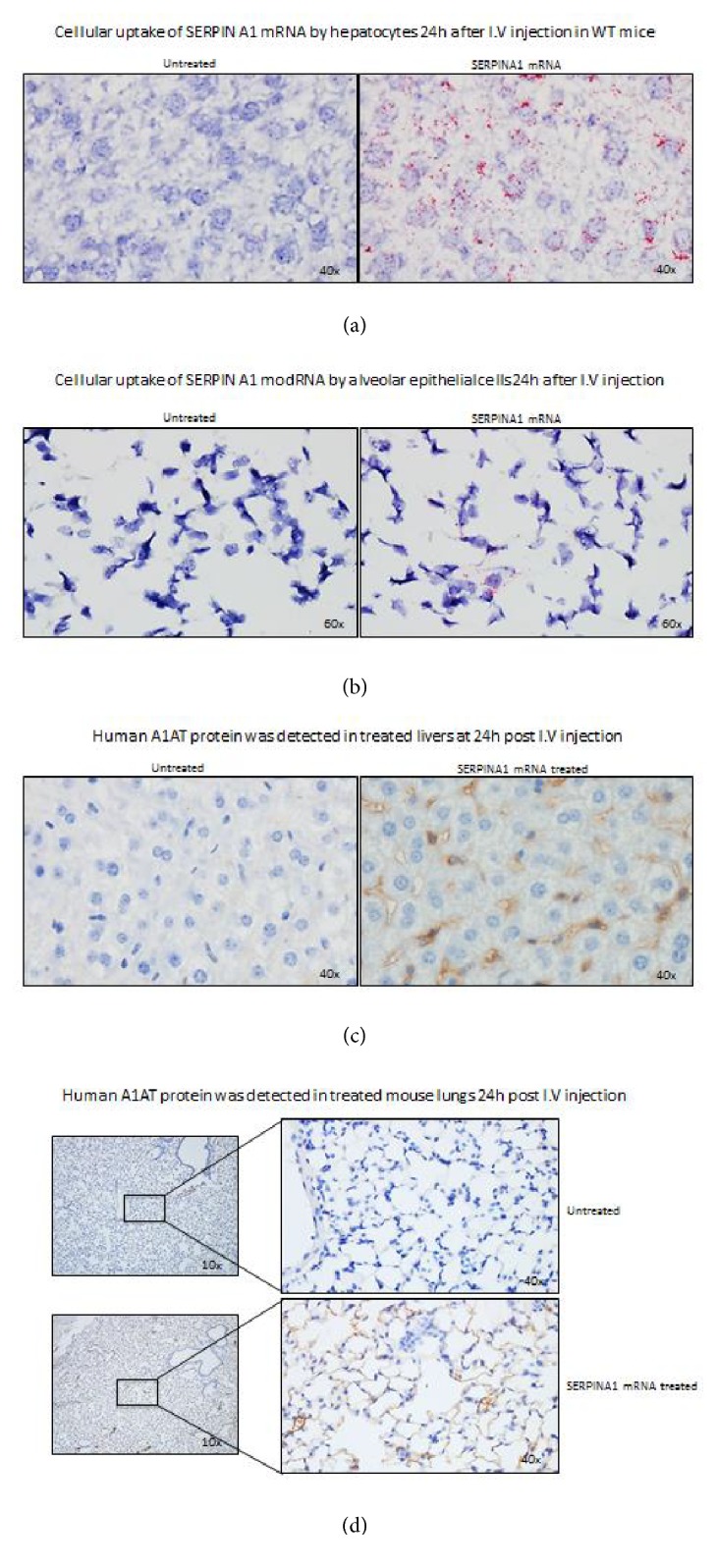 SERPINA1 mRNA as a Treatment for Alpha-1 Antitrypsin Deficiency.